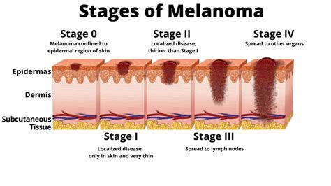 melanoma cancer stages pictures